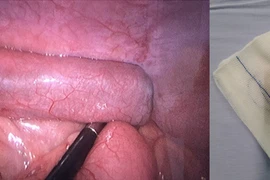 Gắp 4 viên nam châm trong ruột bé trai 7 tuổi