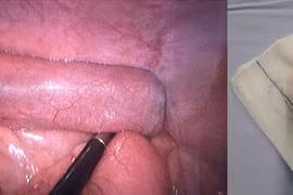 Gắp 4 viên nam châm trong ruột bé trai 7 tuổi