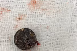 Pin cúc áo "ăn mòn" vách ngăn mũi bé trai 5 tuổi