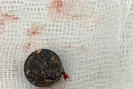 Pin cúc áo "ăn mòn" vách ngăn mũi bé trai 5 tuổi