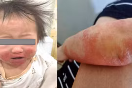 Cảnh giác viêm da cơ địa ở trẻ nhỏ trong mùa hanh khô