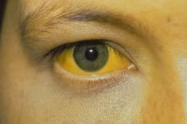 Vàng da, sút cân... cảnh giác với bệnh ung thư đường mật