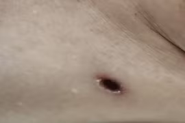 Suy đa tạng do sốt mò, dấu hiệu mắc bệnh cần lưu ý