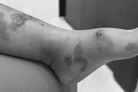 Cảnh báo nguy cơ lây lan bệnh chốc ở trường học