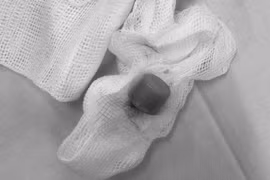 Gắp thành công nắp chai dầu trong cổ cụ ông 74 tuổi