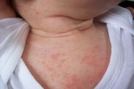Gợi ý 5 loại thực phẩm tốt cho trẻ bị rôm sảy