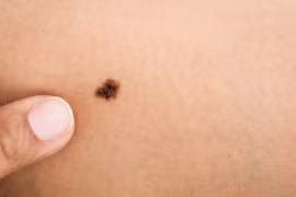 Dấu hiệu cảnh báo ung thư tế bào hắc tố, nhiều người nhầm lẫn