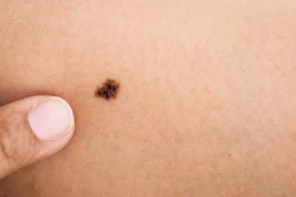 Dấu hiệu cảnh báo ung thư tế bào hắc tố, nhiều người nhầm lẫn