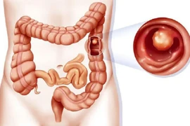 Đi ngoài liên tục, sút cân… đi khám bất ngờ phát hiện ung thư trực tràng