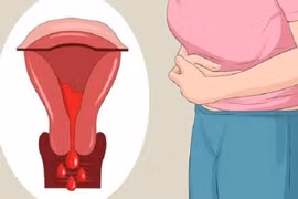 Ra máu âm đạo bất thường, đi khám phát hiện ung thư hiếm gặp