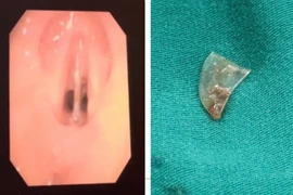 Mảnh nhựa "ngủ quên" giữa 2 dây thanh suốt 4 tháng