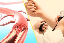 Thói quen xấu hằng ngày có thể khiến huyết áp tăng "vù vù"