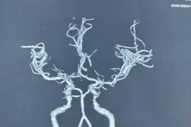 Người phụ nữ đột ngột yếu nửa người sau khi ngủ dậy 