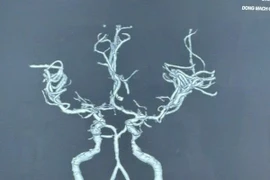 Người phụ nữ đột ngột yếu nửa người sau khi ngủ dậy 