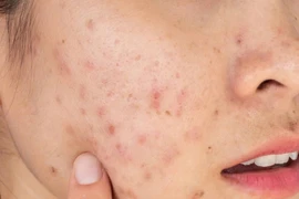 Vì sao da nổi mụn khi đến kỳ "đèn đỏ"?