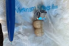 Nuốt cả cầu răng giả khi ăn phở, dị vật thế nào là nguy hiểm?