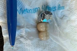 Nuốt cả cầu răng giả khi ăn phở, dị vật thế nào là nguy hiểm?