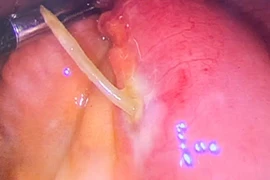 Xương cá xuyên thủng thành ruột non cụ bà 61 tuổi