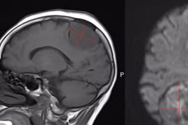 Đau đầu dai dẳng, đi khám bất ngờ phát hiện u màng não