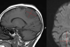 Đau đầu dai dẳng, đi khám bất ngờ phát hiện u màng não