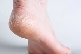 5 cách chăm sóc gót chân khô, nứt nẻ trong mùa đông