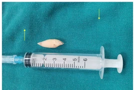 Lấy dị vật đường thở cho bệnh nhân hôn mê do chấn thương sọ não nặng