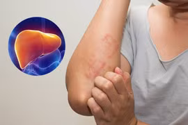 Dấu hiệu trên da cảnh báo gan nhiễm mỡ, cần đi khám ngay