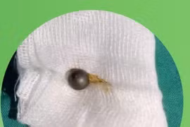 Gắp viên bi sắt trong mũi bé gái 3 tuổi