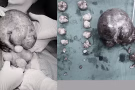 Bóc tách thành công khối u xơ tử cung xoắn tím đen kích thước "khủng"