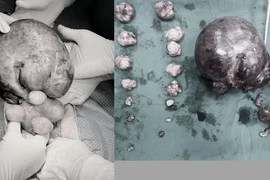 Bóc tách thành công khối u xơ tử cung xoắn tím đen kích thước "khủng"
