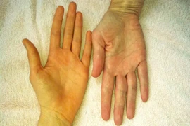 Đột ngột sốt cao, vàng da, vàng mắt, đi khám phát hiện viêm gan A