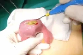 Tắc ruột do thói quen... nhai không kỹ