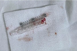 Nô đùa bất cẩn, nữ sinh vô tình bị bạn đâm bút bi vào hốc mắt