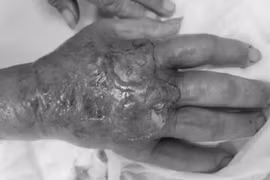 Liên tiếp các ca nhập viện do rắn, động vật có độc cắn sau bão Yagi