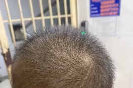 Phẫu thuật thành công cho bé trai 23 tháng tuổi bị đinh vít đâm vào đầu