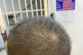 Phẫu thuật thành công cho bé trai 23 tháng tuổi bị đinh vít đâm vào đầu