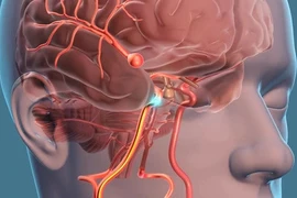 Phình mạch máu não - "Sát thủ thầm lặng tàn phá sức khỏe"