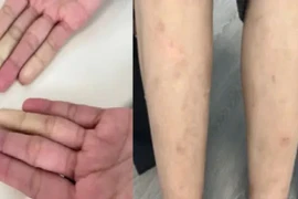 Mệt mỏi, sẩn ngứa, rụng tóc đi khám bất ngờ phát hiện... 2 bệnh tự miễn