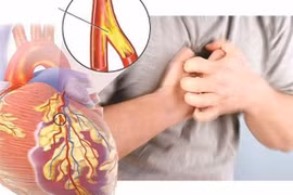 Những ai có nguy cơ cao mắc bệnh động mạch vành?