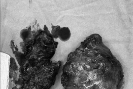 Cắt bỏ khối u bướu giáp "đeo bám" cụ bà 81 tuổi suốt 30 năm