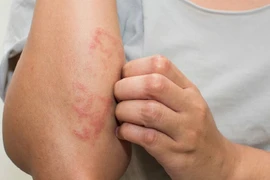 Gan bị nhiễm độc quá nhiều, cơ thể thường có 7 triệu chứng này