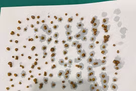 Nội soi lấy 172 viên sỏi trong túi mật người phụ nữ 46 tuổi