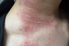 Nhiều người dính độc kiến ba khoang, xử lý tổn thương thế nào?