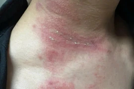 Nhiều người dính độc kiến ba khoang, xử lý tổn thương thế nào?