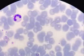 Đi rừng ở nước ngoài về, người đàn ông 31 tuổi mắc sốt rét ngoại lai