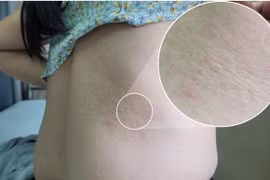 Sẩn ngứa 2 năm, đi khám bất ngờ phát hiện... nhiễm giun chó, mèo