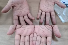 Nhiều người vào viện cầu cứu vì bệnh da mùa mưa