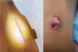 Coi thường mụn nhọt... biến chứng nguy hiểm