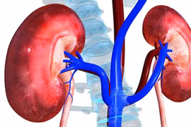 Người đàn ông 45 tuổi bị sốc nhiễm khuẩn, thận ứ mủ do... sỏi niệu quản