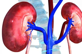 Người đàn ông 45 tuổi bị sốc nhiễm khuẩn, thận ứ mủ do... sỏi niệu quản